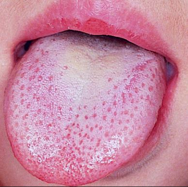 Lie bumps on tongue