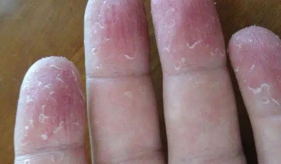 Peeling of Fingertips