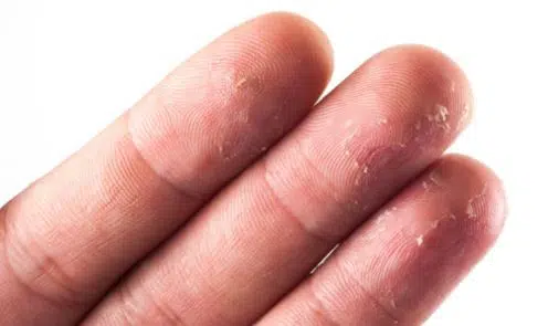 Peeling of Fingertips