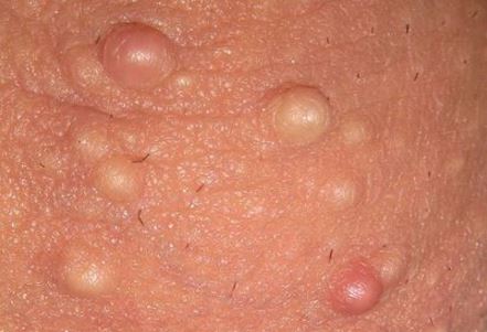 White bumps on scrotum