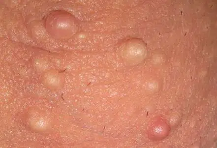 White bumps on scrotum