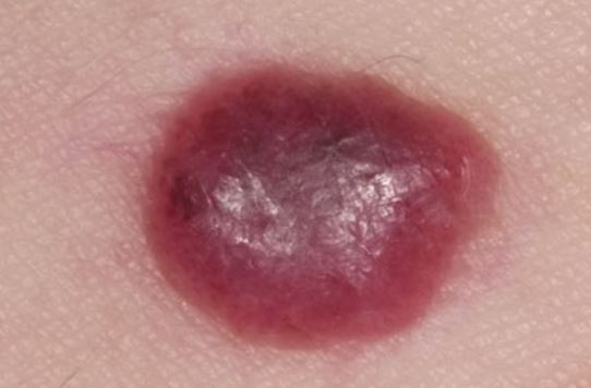 blood blister on breast