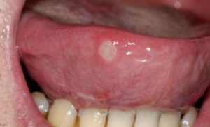 Pain Under Tongue, Sides, White Painful Bump On Tongue, Sores, Causes 