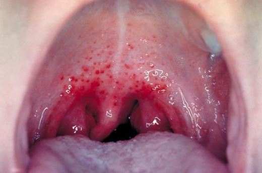 A sore throat can also result in a painful tongue