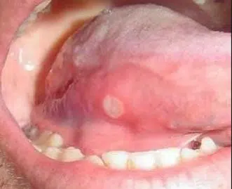 Canker sore white bump under tongue