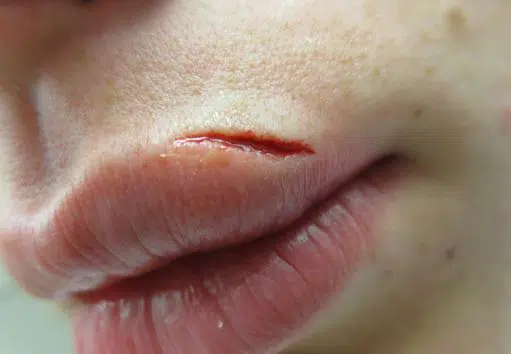 Cut above lip
