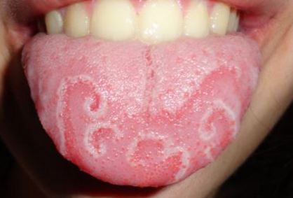 Geographic tongue may cause white bumps on tongue