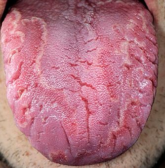 Geographic tongue or tongue fissures can make it painful or sore.