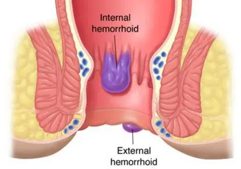 How to get rid of hemorrhoids fast naturally permanently