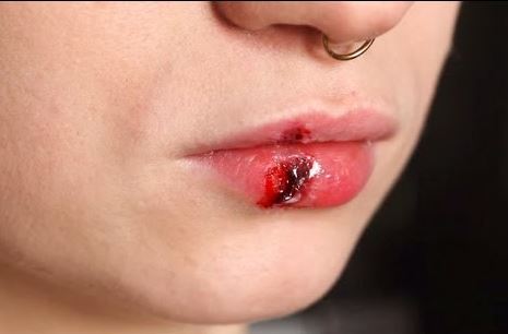 How to heal a cut lip