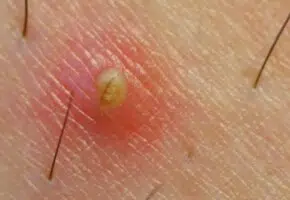 Ingrown hair on thighs forming a cyst