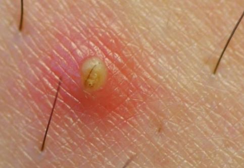 Ingrown hair on thighs forming a cyst