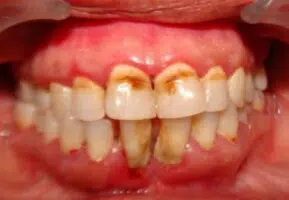 Mottled teeth