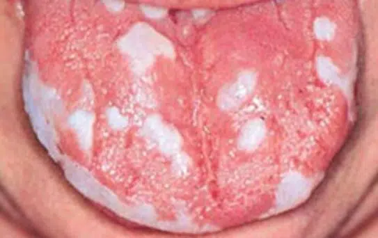 Oral thrush and white spots and patches on tongue