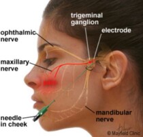 gabapentin facial twitching