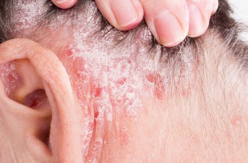 Dry flaky rash behind the ear due to eczema