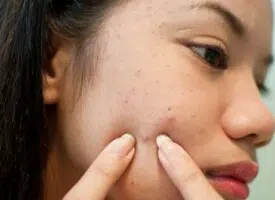 How to remove black spots on face fast