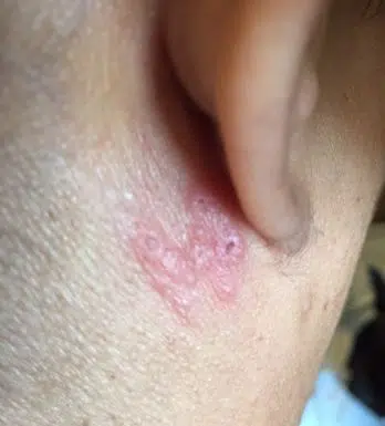 Shingles rash behind ear