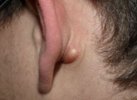Swollen lymph nodes behind ear
