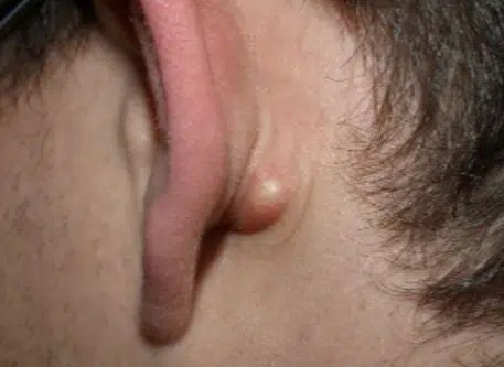 Swollen lymph nodes behind ear