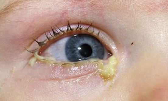 Toddler eye discharge