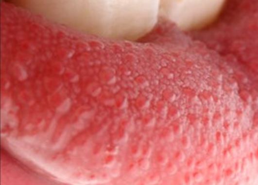 red dots on tongue 