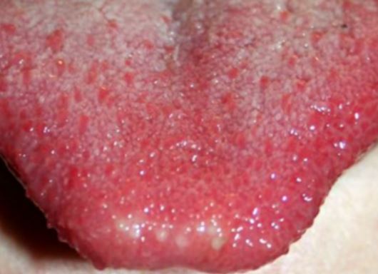 red dots on tongue 