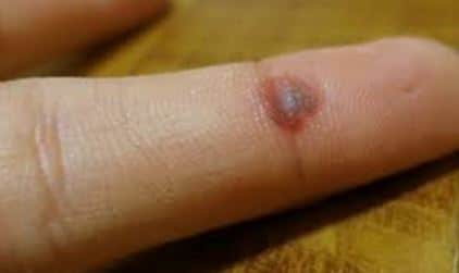 Blood blister on fingers