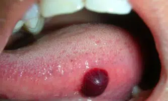 Blood blister under tongue