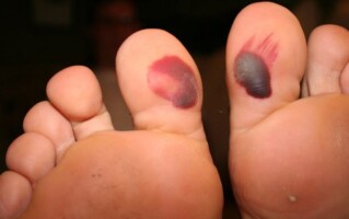 Blood blisters on toes