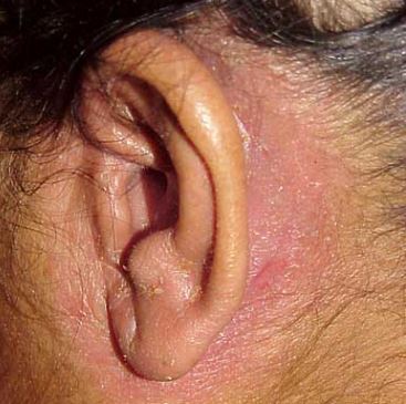 Dry peeling skin behind ear