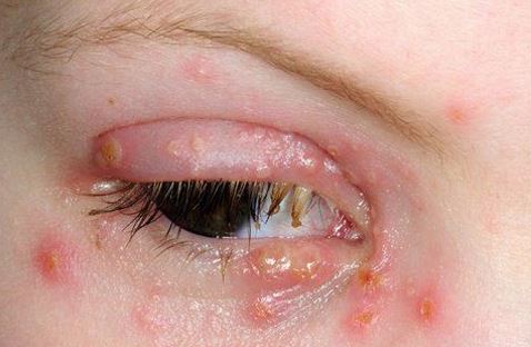 Eye herpes can also lead to discharge