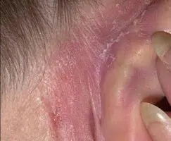 Flaky dry skin behind ear