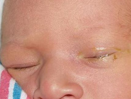 Greenish eye discharge in toddlers
