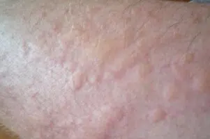 Heat lumps on legs, skin