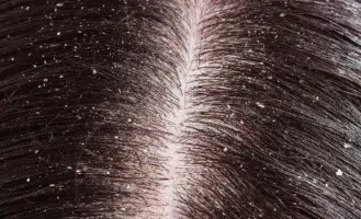 How to get rid of dandruff fast permanently