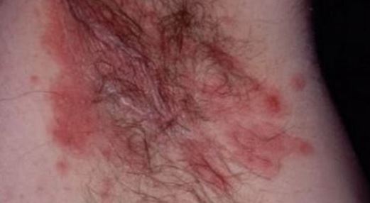 Itchy rash under armpit