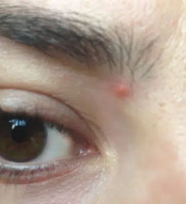 Pictures of a pimple on the eyebrow line