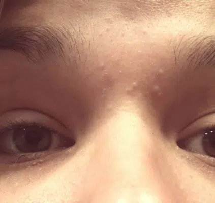 Pimples between eyebrows