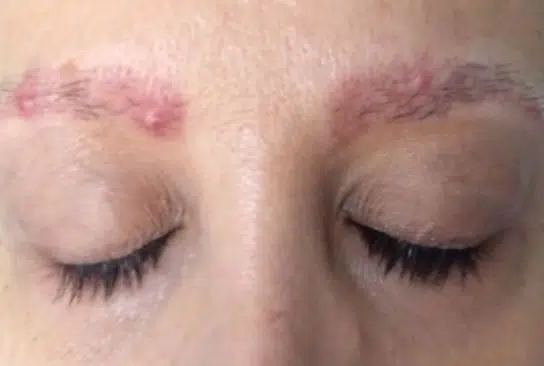 Pimples on eyebrows after threading or waxing