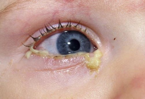Pink eye may cause toddler eye discharge