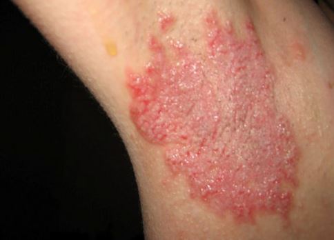 Severe red underarm rash