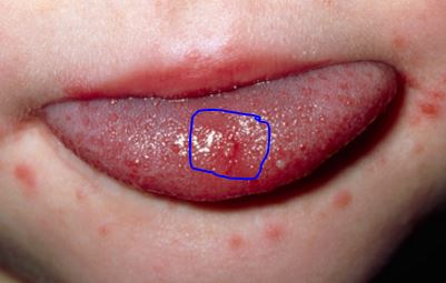 Small red blisters on tongue of baby