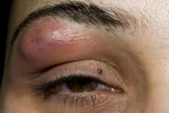 Swollen pimple on eyebrow above eyelid