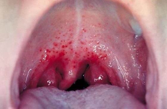 An allergic reaction in your throat can also cause it to be sore