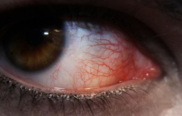 Red veins in eye