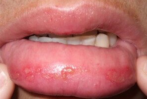 Sunburned Lips: Blisters, Swollen Rash, Remedies to Heal Fast & How ...