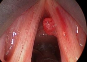 Throat polyps