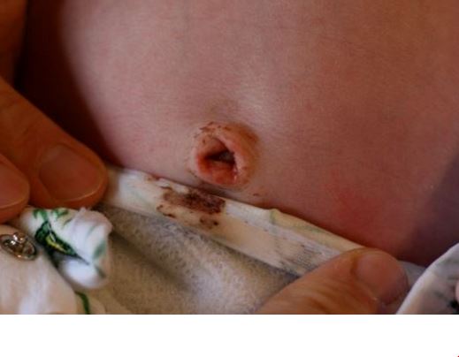 A bloody navel discharge in baby