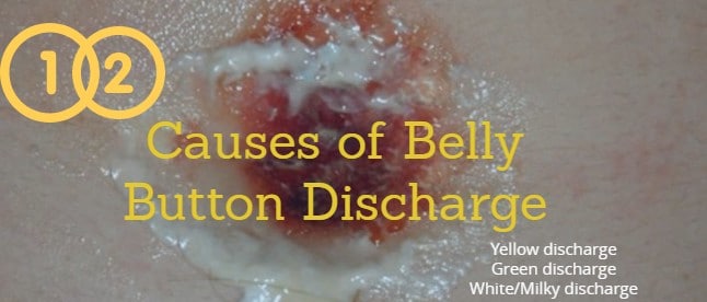 Belly button discharge